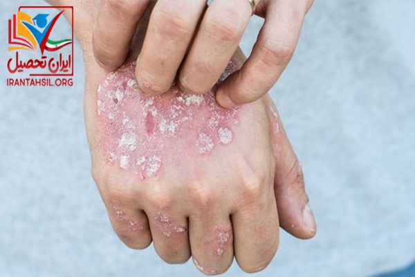 معافیت اگزما پوستی