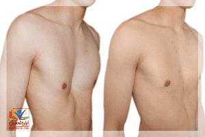 معافیت تغییر شکل قفسه سینه