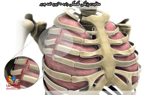 معافیت شکستگی دنده