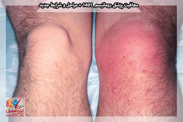 آرتریت‌های عفونی ناشی از تروما در مفاصل بزرگ