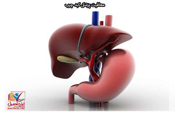 شرایط معافیت کبدچرب