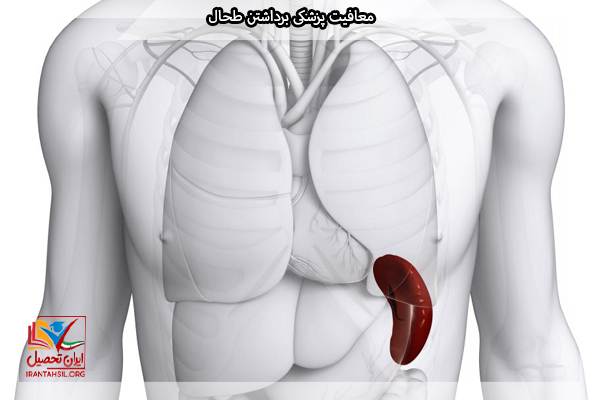 معافیت سربازی جراحی طحال