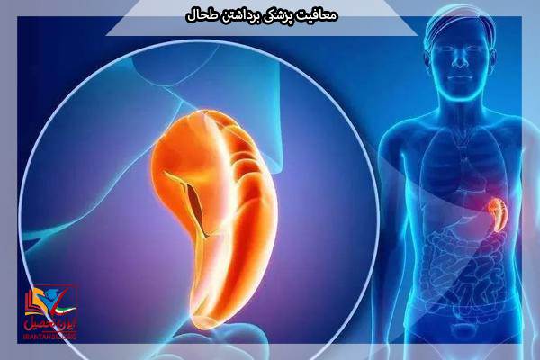 معافیت عمل جراحی طحال