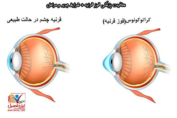 دریافت معافیت پزشکی قوز قرنیه