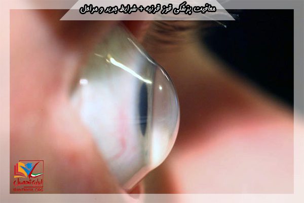شرایط معافیت پزشکی قوز قرنیه