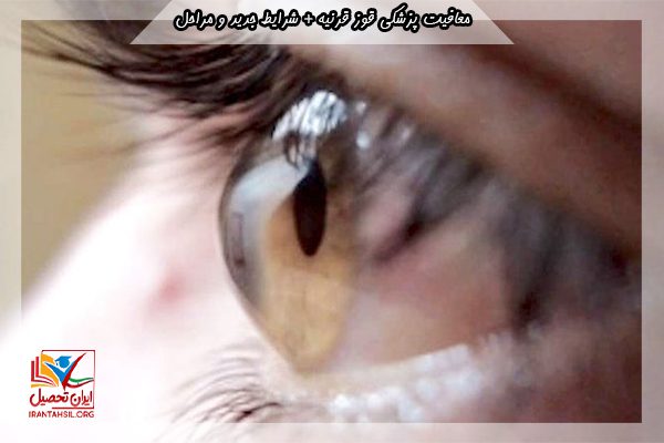 معافیت دائم پزشکی قوز قرنیه